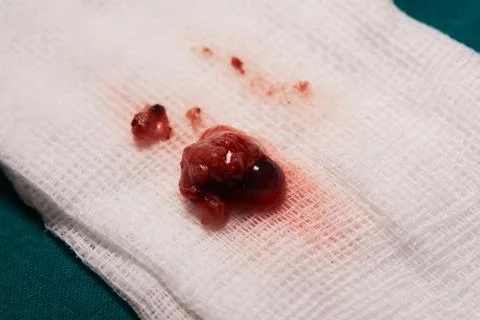 Close-up view of abnormal vascular in the brain causing seizure. Stock Photos