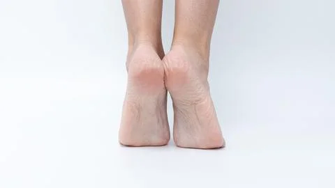 Close-up view of bare feet showcasing corns and calluses, highlighting foot Stock Photos