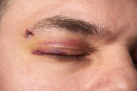 Close view of a black eye, man's face with a hematoma Stock Photos