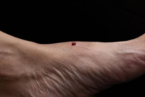 Close-up view of bleeding on the foot from leech biten. Stock Photos
