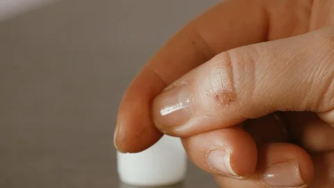 Close-up view to clean the wound on the thumb of the right hand Stock Footage 105303463