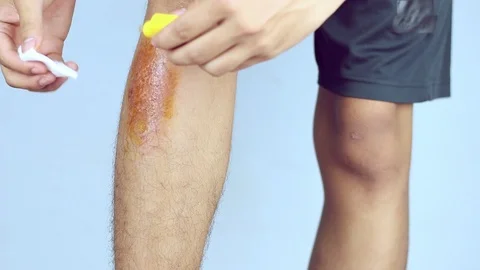 Close-up view of cleaning a bleeding wound under the shin After the accident, Stock Footage 91383196