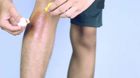 Close-up view of cleaning a bleeding wound under the shin After the accident, Stock Footage 91383311