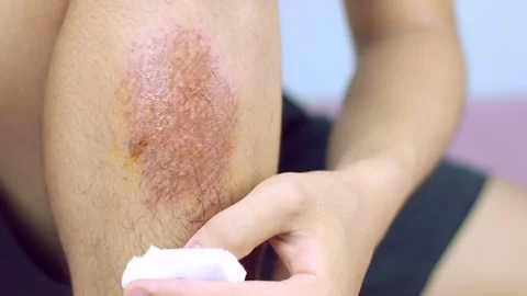 Close-up view of cleaning a bleeding wound under the shin After the accident, Stock Footage 91383488