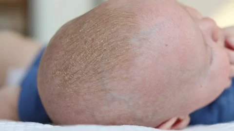 Close-up view of cradle cap or seborrhea on the infants head Stock Footage 153521794