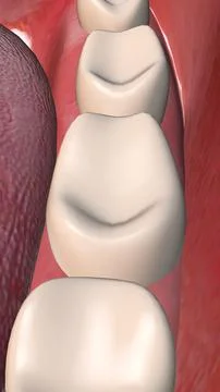 Close-Up View of Decaying Molar Teeth Ilustración de archivo