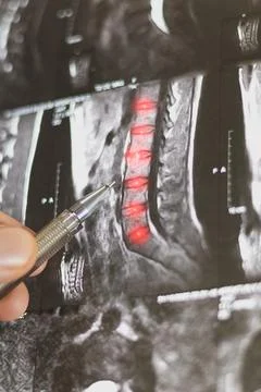 Close up view of diagnosing x-ray human spine. Vertical image. Stock Photos