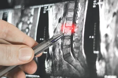 Close up view of diagnosing x-ray human spine. Stock Photos