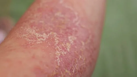Close-up view of the eczema on a person's arm. 動画素材 189126936