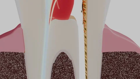 Close view of endodontic rotary file inside molar root canal, 4K Stock Footage 346121103