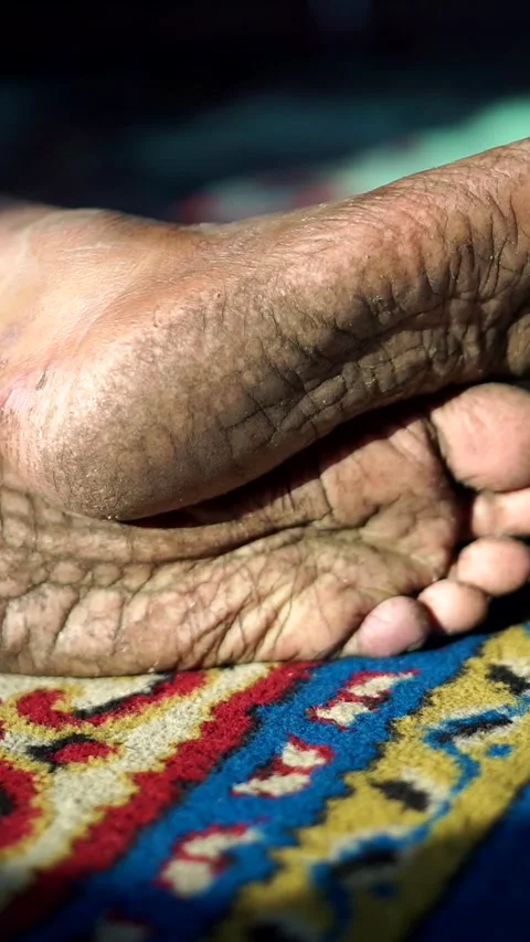 Close-up view of extremely dry, cracked, and heavily wrinkled human foot soles. Stock-Footage 340582038
