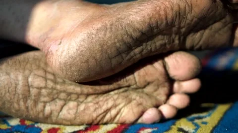 Close-up view of extremely dry, cracked, and heavily wrinkled human foot soles. Video stock 340582320