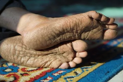 Close-up view of extremely dry, cracked, and heavily wrinkled human foot soles. Stock Photos