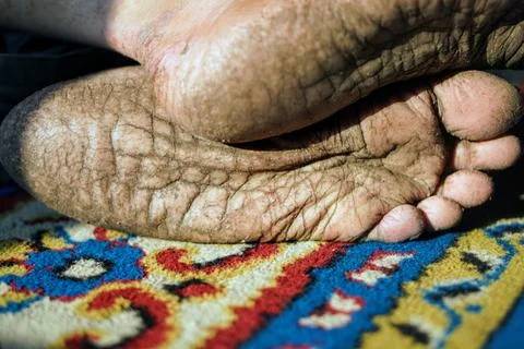 Close-up view of extremely dry, cracked, and heavily wrinkled human foot soles. Stock Photos