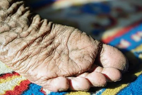 Close-up view of extremely dry, cracked, and heavily wrinkled human foot soles. Stock Photos