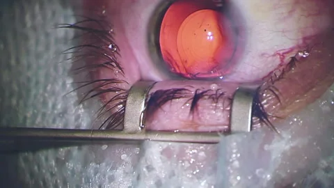 Close-up view of the eye on the laser machine screen during vision correction Stock Footage 154135655