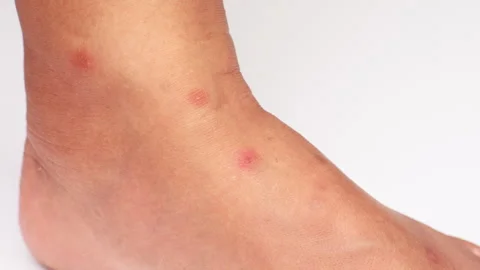 Close up view of flea bites on lower legs and feet skin. Video stock 313190814