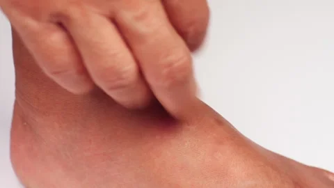 Close up view of flea bites on lower legs and feet skin. Stock Footage 313190833