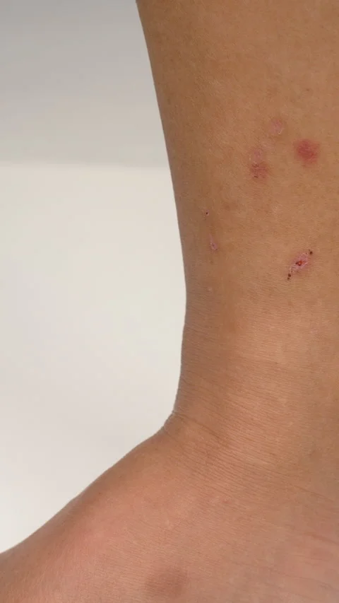 Close up view of flea bites on lower legs and feet skin. Stock Footage 315514548
