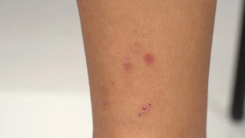 Close up view of flea bites on lower legs and feet skin. Video stock 315514551