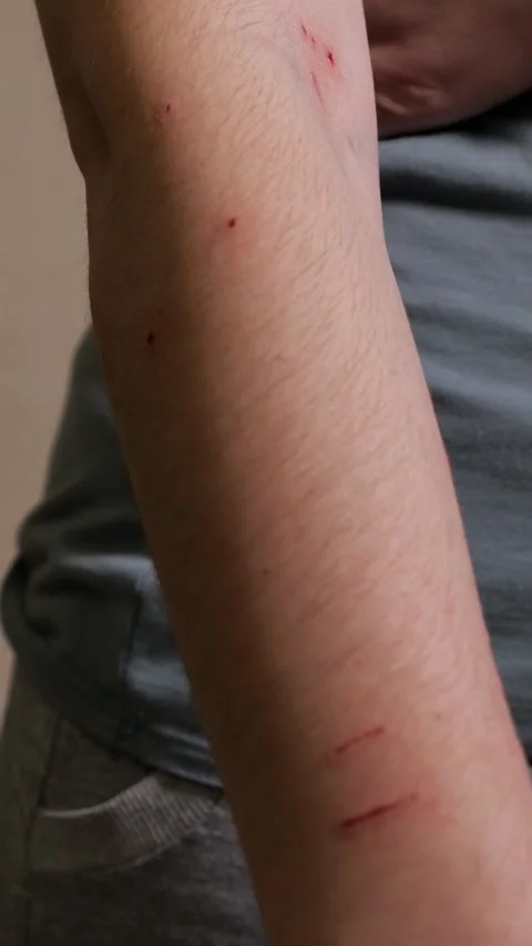 Close up view of a forearm with fresh, red bleeding scratches, cuts, and wounds Stock Footage 344798288