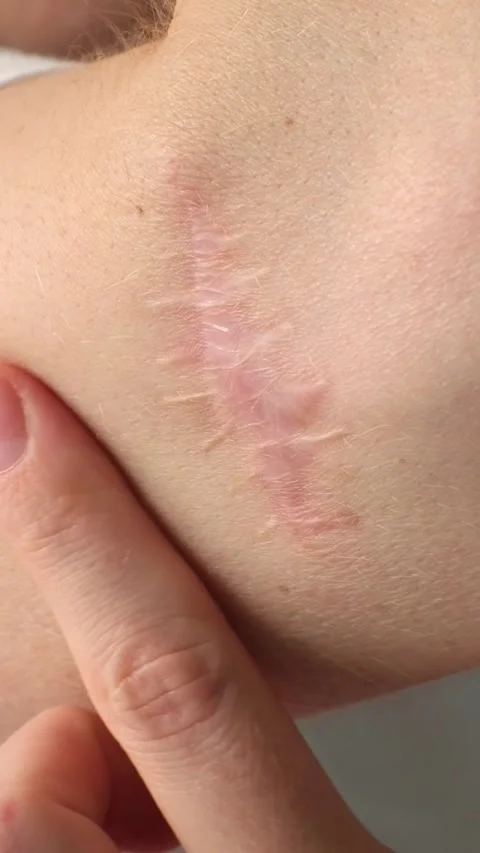 Close-up view of forearm scar post-melanoma removal, illustrating the healing Stock Footage 315573565
