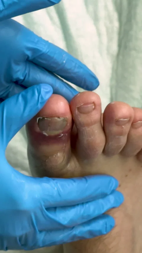 Close-up view of a gloved hand examining an injured toe with visible swelling Stock-Footage 335524816