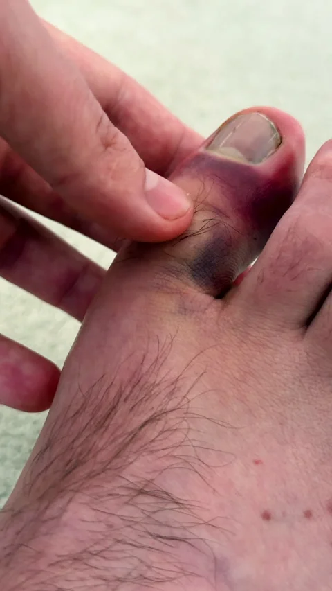 Close-up view of a hand examining a purple inflamed toe, showing visible Stock Footage 336546457
