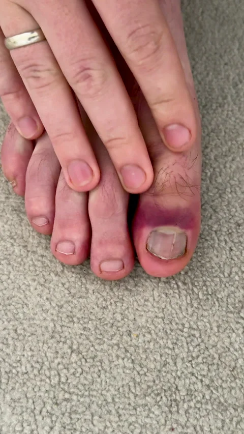Close-up view of a hand inspecting a bruised toe on a foot, showing visible Видео 336546144
