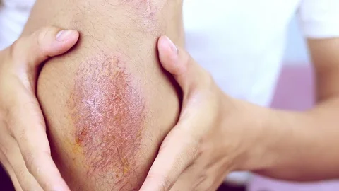 Close-up view of hind legs After the accident, traumatic pain, burns. Stock Footage 91096988