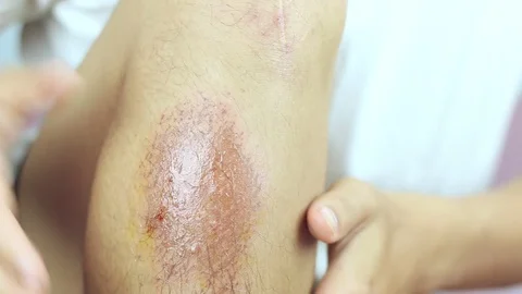 Close-up view of hind legs After the accident, traumatic pain, burns. Stock Footage 91383351