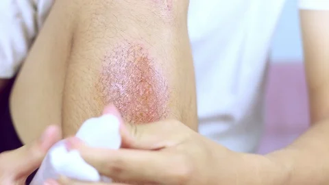 Close-up view of hind legs After the accident, traumatic pain, burns. Stock Footage 91383420