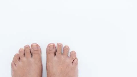 Close-up view of human feet with ingrown toenails on a clean white background Stock Photos