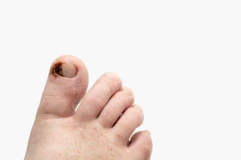 Close-up view of a human foot featuring a big toe with a noticeable wound, di Stock Photos