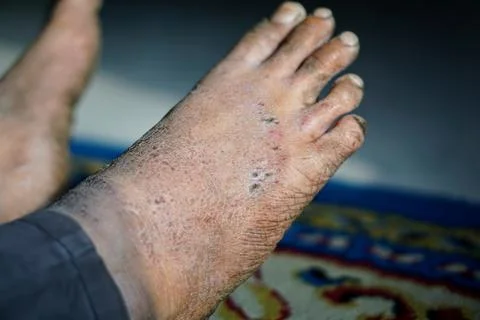 Close-up view of a human foot with severe skin infection, scaly rash Stock Photos