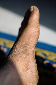Close-up view of a human foot with severe skin infection, scaly rash Stock Photos