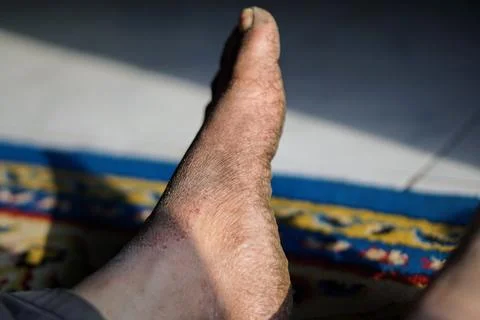 Close-up view of a human foot with severe skin infection, scaly rash Stock Photos