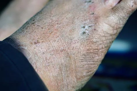 Close-up view of a human foot with severe skin infection, scaly rash Stock Photos