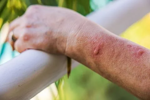 Close-up view of human forearm with multiple red insect bites and irritated skin Stock Photos