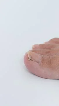 Close-up view of a human toe with nail fungus, showcasing the affected area and Stock Photos