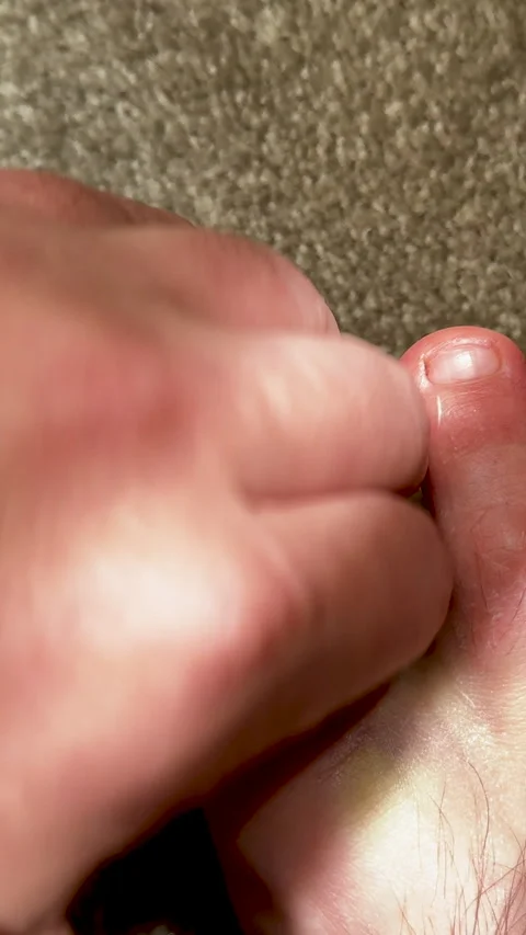 Close-up view of an inflamed and bruised human finger being examined with 動画素材 340274519