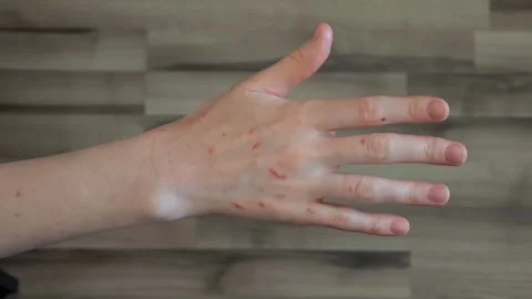 Close-up view of injured hand Stock Footage 309505832