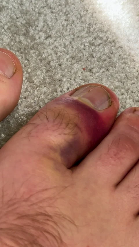 Close-up view of injured toe with visible skin discoloration and swelling Video stock 335525112