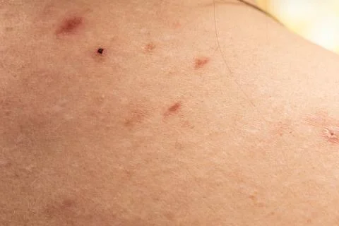 A close-up view of insect bites on human skin, towards the upper back and sho Stock-Fotos