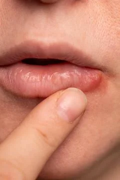 Close up View of a Lip With Herpes Simplex Virus Lesion Stock Photos
