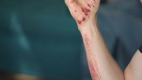 Close up view of a mans bleeding wound under the skin after the accident Stock-Footage 133240594