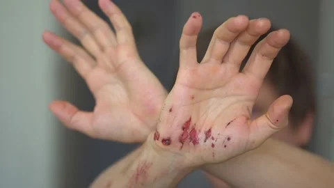Close up view of a mans bleeding wound under the skin after the accident Stock Footage 136188279
