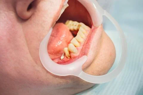 Close view of men's decayed  teeth  in a mouth Foto stock