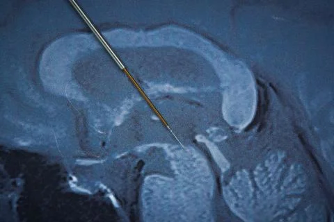 Close-up view of microelectrode recording on brain mri Stock Photos