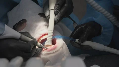 Close-up view of a patient receiving professional teeth cleaning and polishing 库存影片 339274059